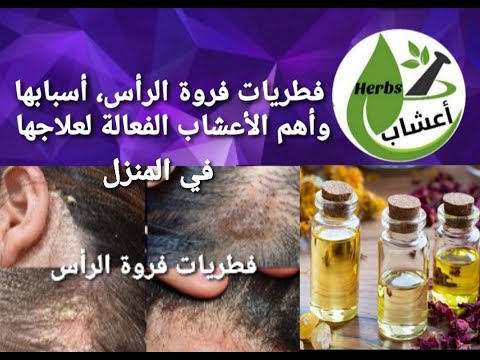 علاج فطريات فروة الرأس و القشرة بالأعشاب و الزيوت الطبيعية قناة اعشاب أعشاب قشرة الراس فطريات