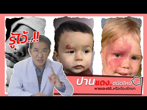 ปานแดง(Vascular Birhtmark) ความผิดปกติแต่กำเนิดที่ไม่ควรมองข้าม ชนิดไหนหายเองชนิดไหนต้องรีบรักษา