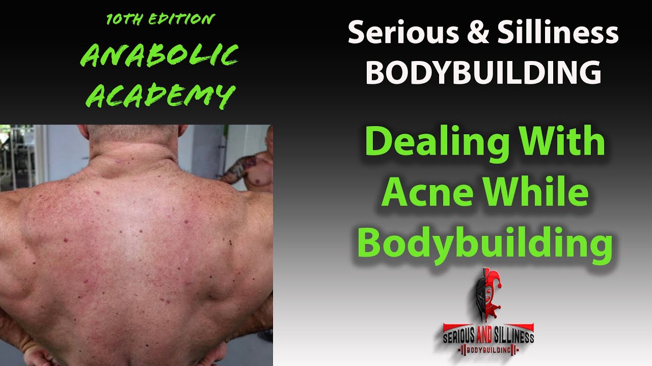 10th Edition of ANABOLIC ACADEMY Dealing With Acne While Bodybuilding