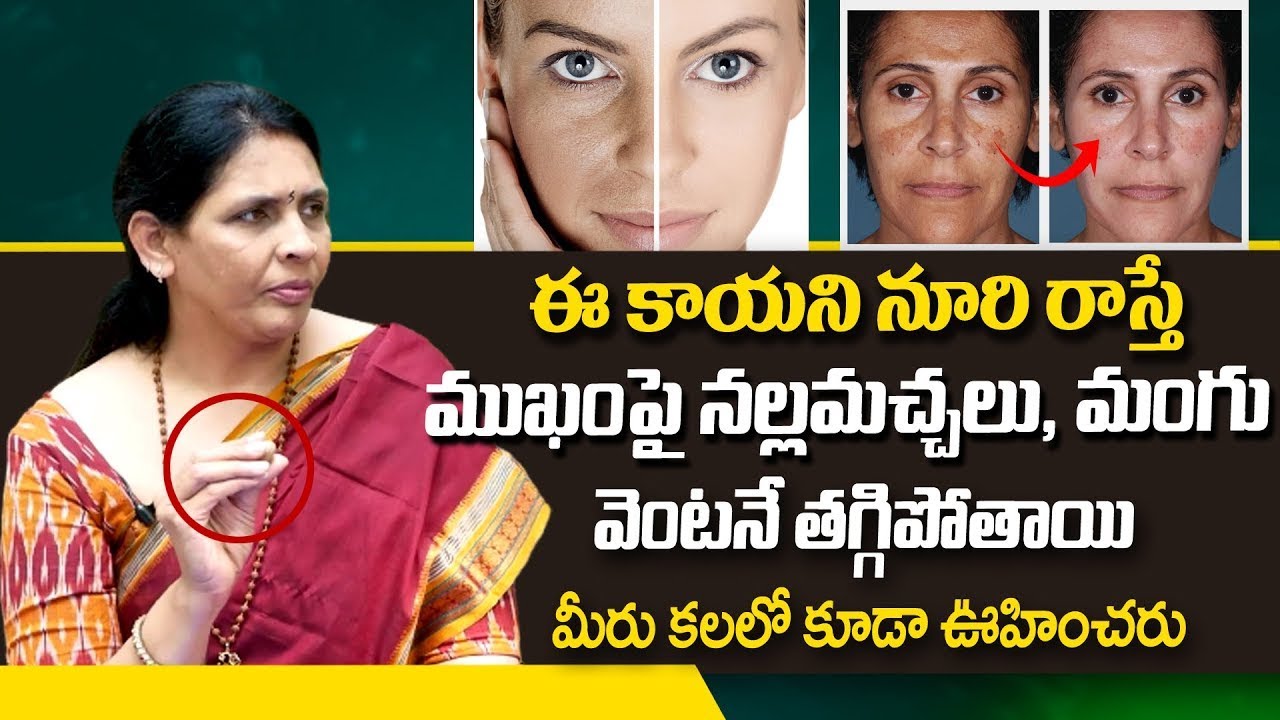 ముఖముపై నల్లమచ్చలు, మంగు వెంటనే తగ్గిపోతాయి || Pigmentation Problems || Yoga Guru Aruna Devi