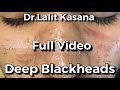 Deep blackhead removal full by drlalit kasana