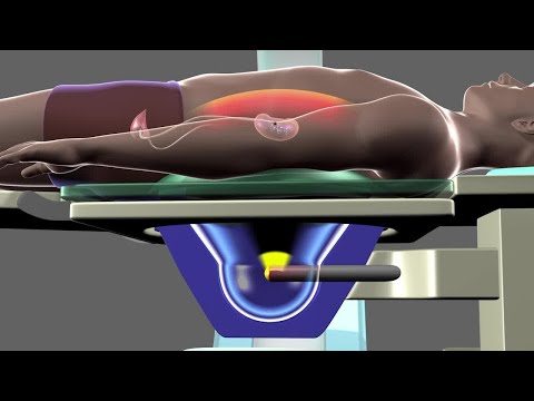 Shockwave Lithotripsy