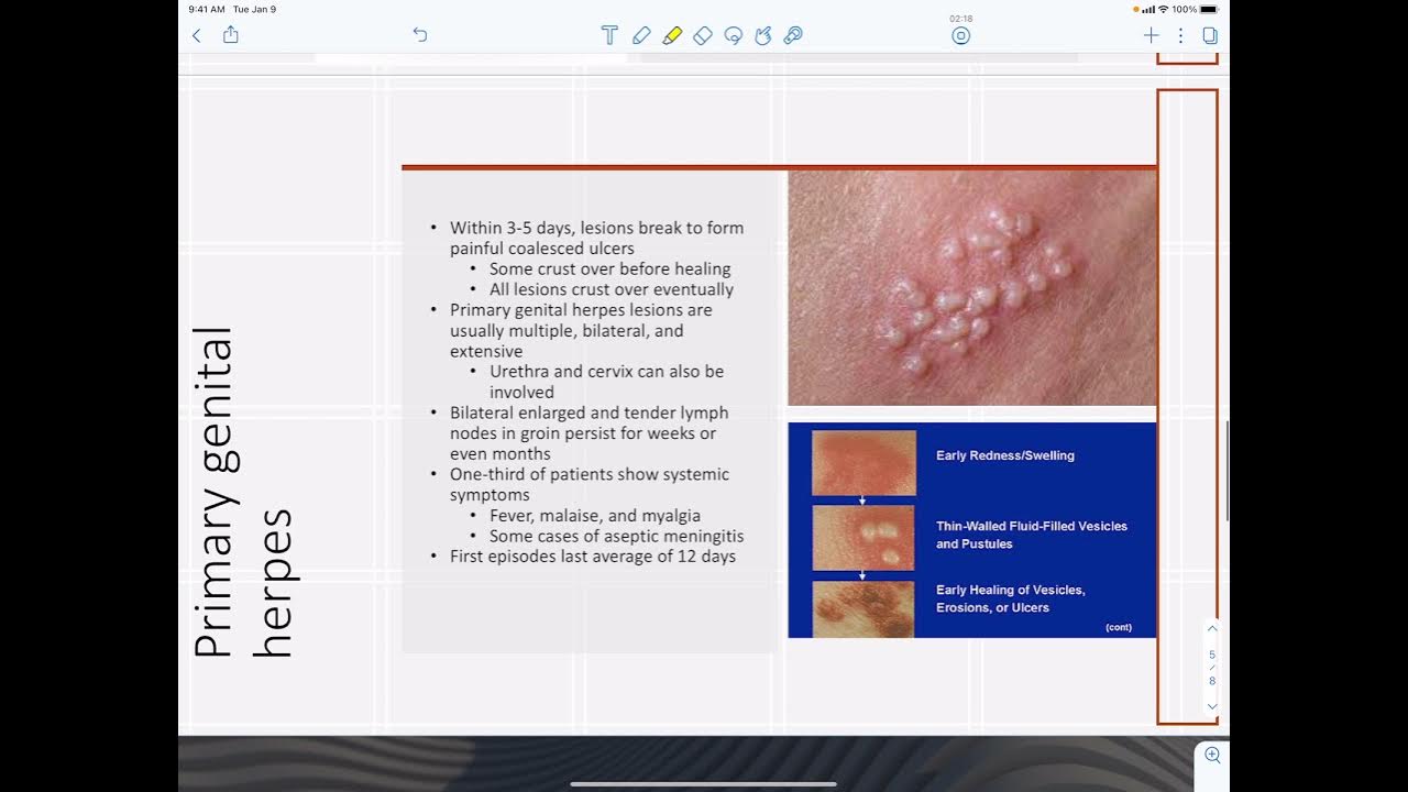 hsv-2-infections-youtube