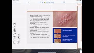 HSV 2 infections