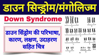 डाउन सिंड्रोम क्या है | down syndrome in hindi class 12 biology | down syndrome ke lakshan Mongolism