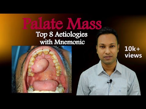 Palate Mass: Top 8 Aetiologies with Picture and Mnemonic