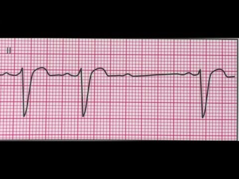 Vidéo: Bloc Cardiaque (Mobitz Type II) Chez Les Chiens