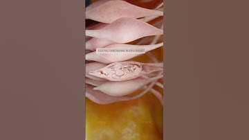 Is ductal carcinoma in situ a risk for developing invasive breast cancer? 3D visualization