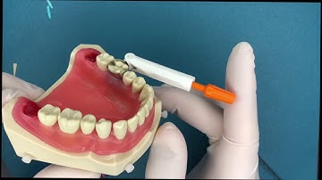 Disposable Band Matrix
