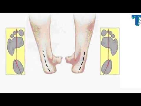 ტერფის პრობლემების დიაგნოსტიკა და კორექცია კლინიკა ,,ტერდში''