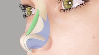 Saddle Nose or Ski Slope Nose Rhinoplasty Nosejob