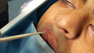 Fistula and Lip Scar Revision Surgery - Dr. Sunil Richardson