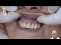 Como recuperar a porcelana e o dente com cirurgia.Dr Antônio Sérgio F Freitas