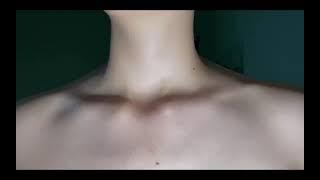 Carotid pulse and rapid heartbeat when a girl is standing