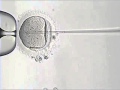 Intracytoplasmic sperm injection procedure icsi