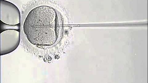 Intracytoplasmic Sperm Injection Procedure (ICSI)