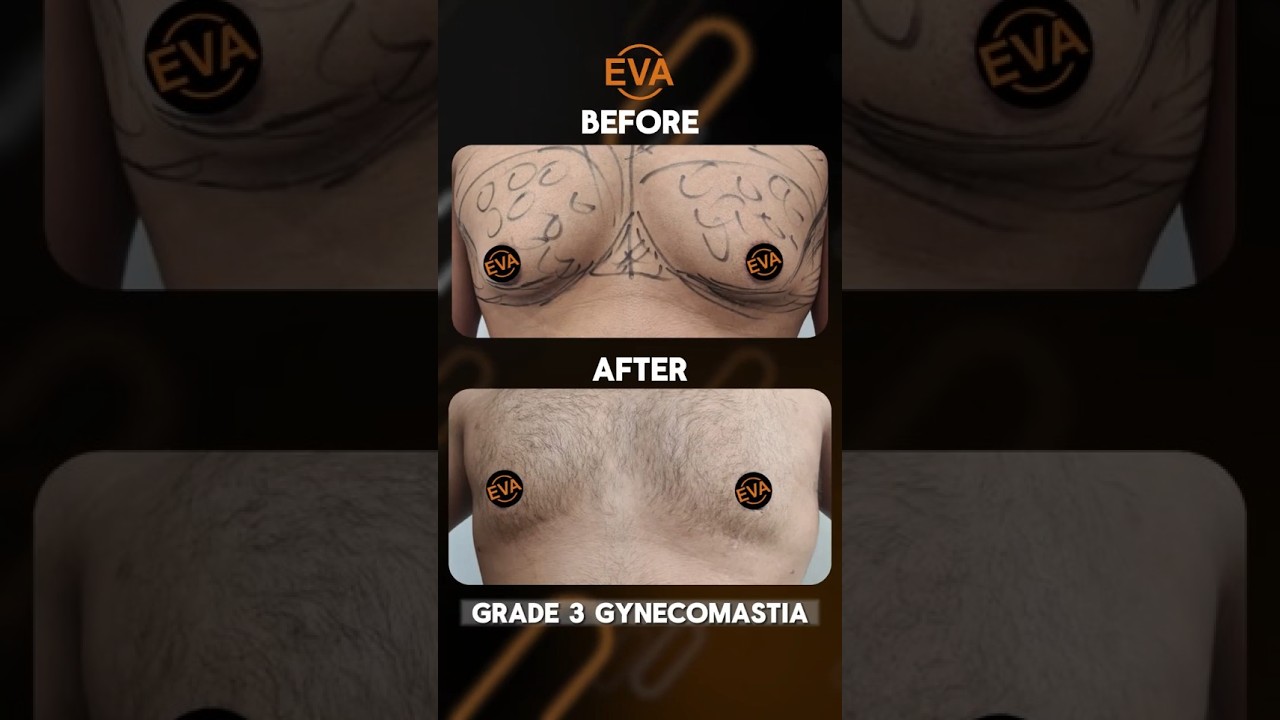 Gynecomastia Before After Result #amazing gynecomastia transformation#drhiranmayijha