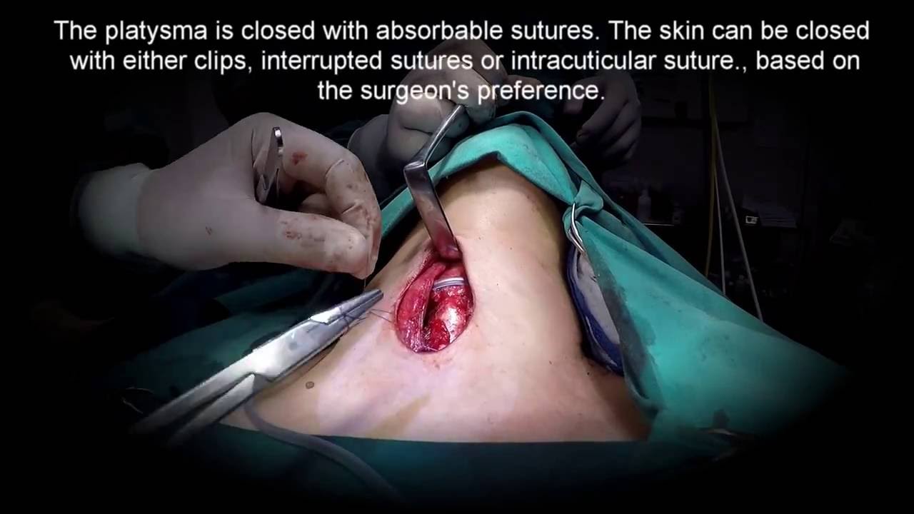 thyroidectomy technique youtube