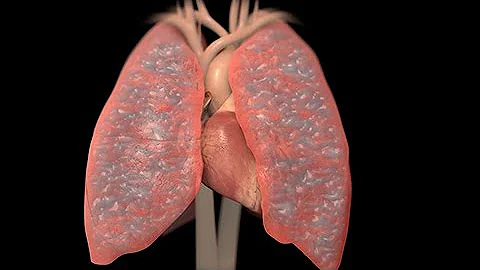 ¿Qué ocurre con los pulmones en la insuficiencia cardíaca?