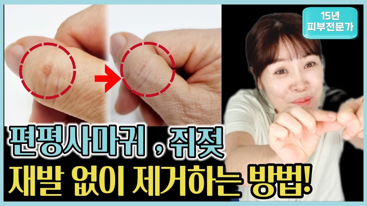 쥐젓,편평사마귀,비립종 방치하지 말고 집에서 영구 삭제하기! /절대 재발하지 않아요 - YouTube