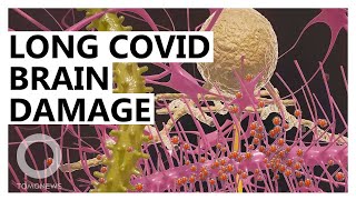 Coronavirus Brain Damage: Two Ways COVID-19 Can Cause Long COVID