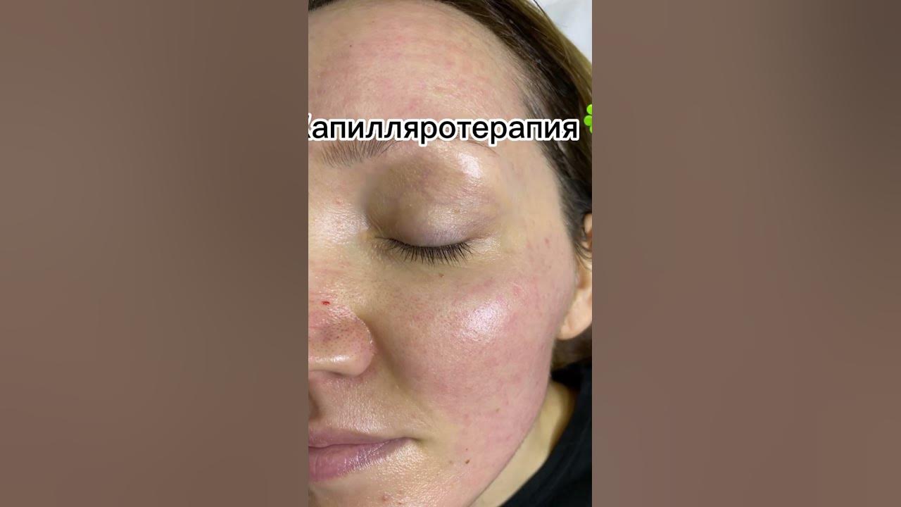 Брашинг! Вот Решение от Прыщей? Все Что Надо Знать - YouTube Косметология, Типы