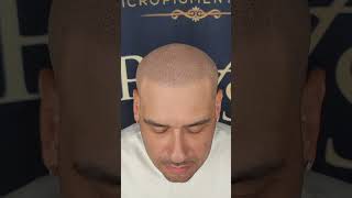 Dealing with balding or thinning hair?Scalp Micropigmentation (SMP) is the Solution.