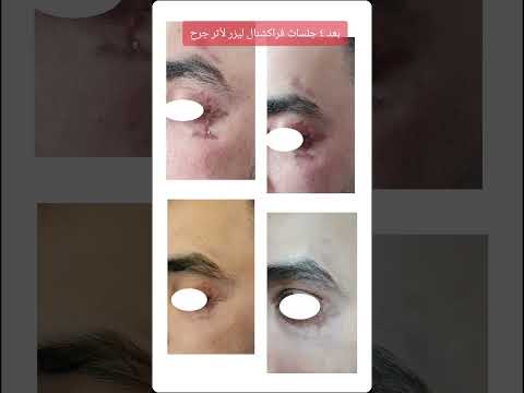 بعد ٤ جلسات فراكشنال ليزر لأثر جرح حول العين فراكشنال ليزر