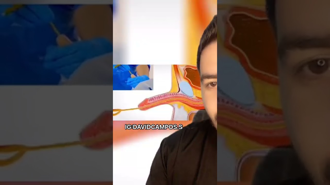 ASI SE COLOCA UNA SONDA VESICAL