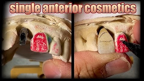 Screw-Retained Single Crown: How to Shade & Contour to Match