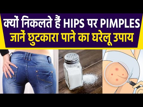 जानें क्‍यों निकलते हैं Hips पर Pimples, छुटकारा पाने का ये है घरेलू उपाय | Butt Acne | Boldsky