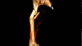 Proximal humerus fracture - metaphysis to diaphysis communited