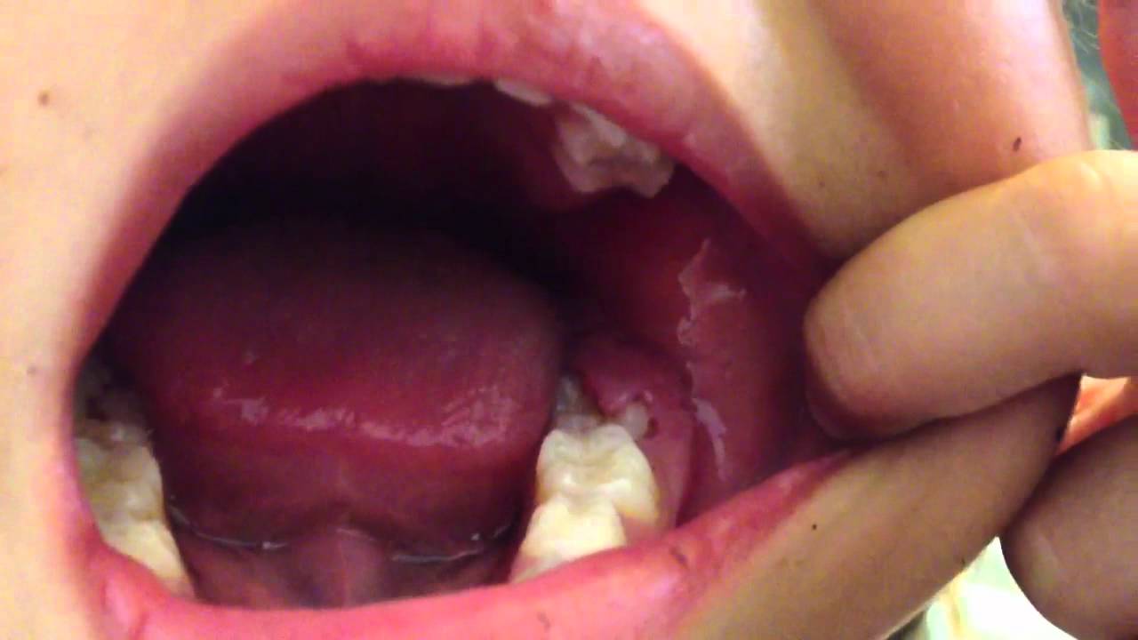 奥歯 生え てき た 痛い