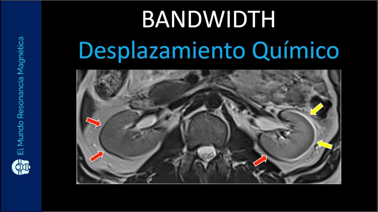 PARÁMETROS Resonancia Magnética. BANDWIDTH, Desplazamiento Químico rmn. Desplazamiento AGUA GRASA