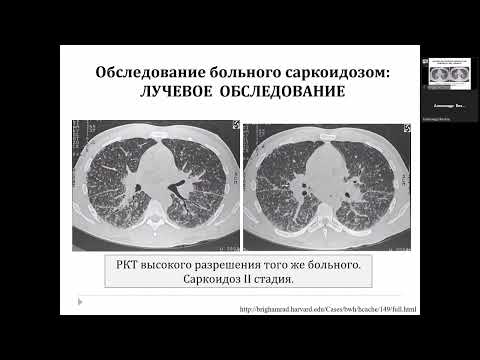 Саркоидоз. Современное состояние проблемы. Вопросы диагностики