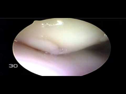 lesion chondral patella