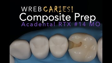 Class II #14 MO Preparation RTX Caries Tooth for WREB