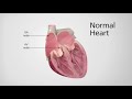 Normal Heart vs. Heart in AFib