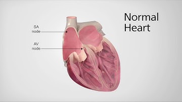 Normal Heart vs. Heart in AFib