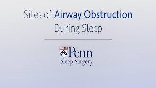 Introduction to Obstructive Sleep Apnea | Penn Sleep Surgery screenshot 5