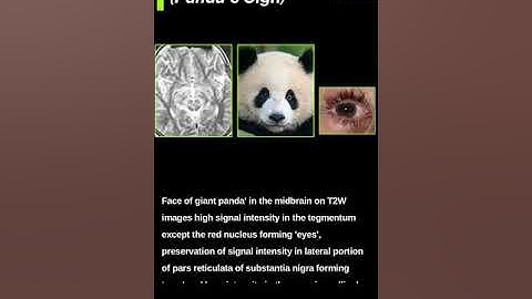 Wilsons Disease(Panda