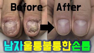 남자 손톱교정 - 울퉁불퉁한 손톱