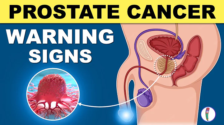 Prostate Cancer Signs | Warning Signs of Prostate Cancer - DayDayNews
