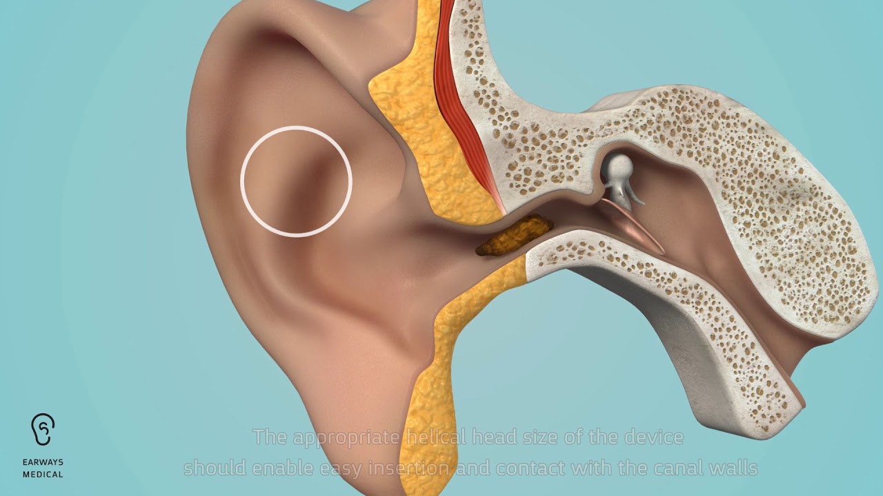 EarWay® PRO Tutorial