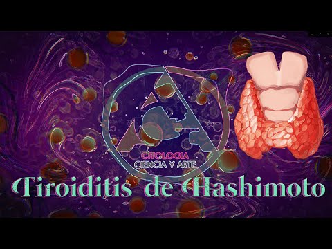 Que es tiroiditis de hashimoto