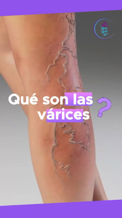 The famous #varicose veins: Discover what they really are and how they affect your veins in this ...