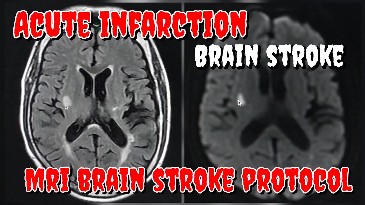 Acute Infarction In MRI Brain MRI Brain Stroke Protocol DWI ADC Acute Infarction In MRI Brain MRI Brain Stroke Protocol DWI ADC