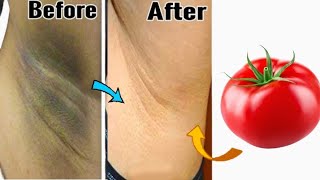 Whiten your underarm naturally in 2 minutes - home remedy for dark underarms