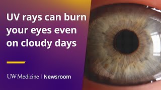 UV rays can burn your eyes even on cloudy days
As climate change becomes more intense across our country, it’s important to protect your eyes from increased heat, pollen and UV radiation. It’s not just a challenge faced by agricultural or construction workers, but anyone who ventures outside, even on a cloudy day, said UW Medicine ophthalmologist Dr. Andrew Chen.
“Increased UV rays can have a variety of effects on the eyes. Starting from the outside in, you get an effect similar to sunburns on the surface of the eye called keratitis, and thats where UV rays can damage the epithelial cells on the surface of the cornea, leading to eye pain, redness, irritation, blurry vision, very similar to a sunburn effect on your skin,” said Chen, an assistant professor of ophthalmology at the University of Washington School of Medicine. “But in addition to that, deeper inside the eye, you can have an acceleration of cataract formation and cataracts are the leading cause of reversible blindness worldwide.”
Chen recommends first, be aware that you need to protect your eyes.
Chen suggests having some form of UV protection with sunglasses or even finding shade, covering with clothing like a hat, or staying under an outdoor shelter. UV rays can burn your eyes even on cloudy days