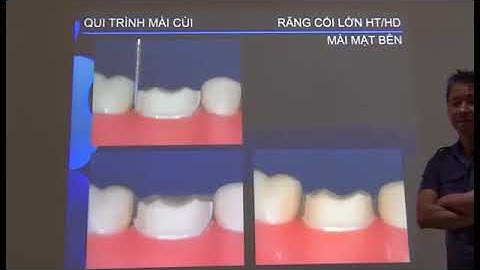 15 quy trình mài cùi răng cối lớn
